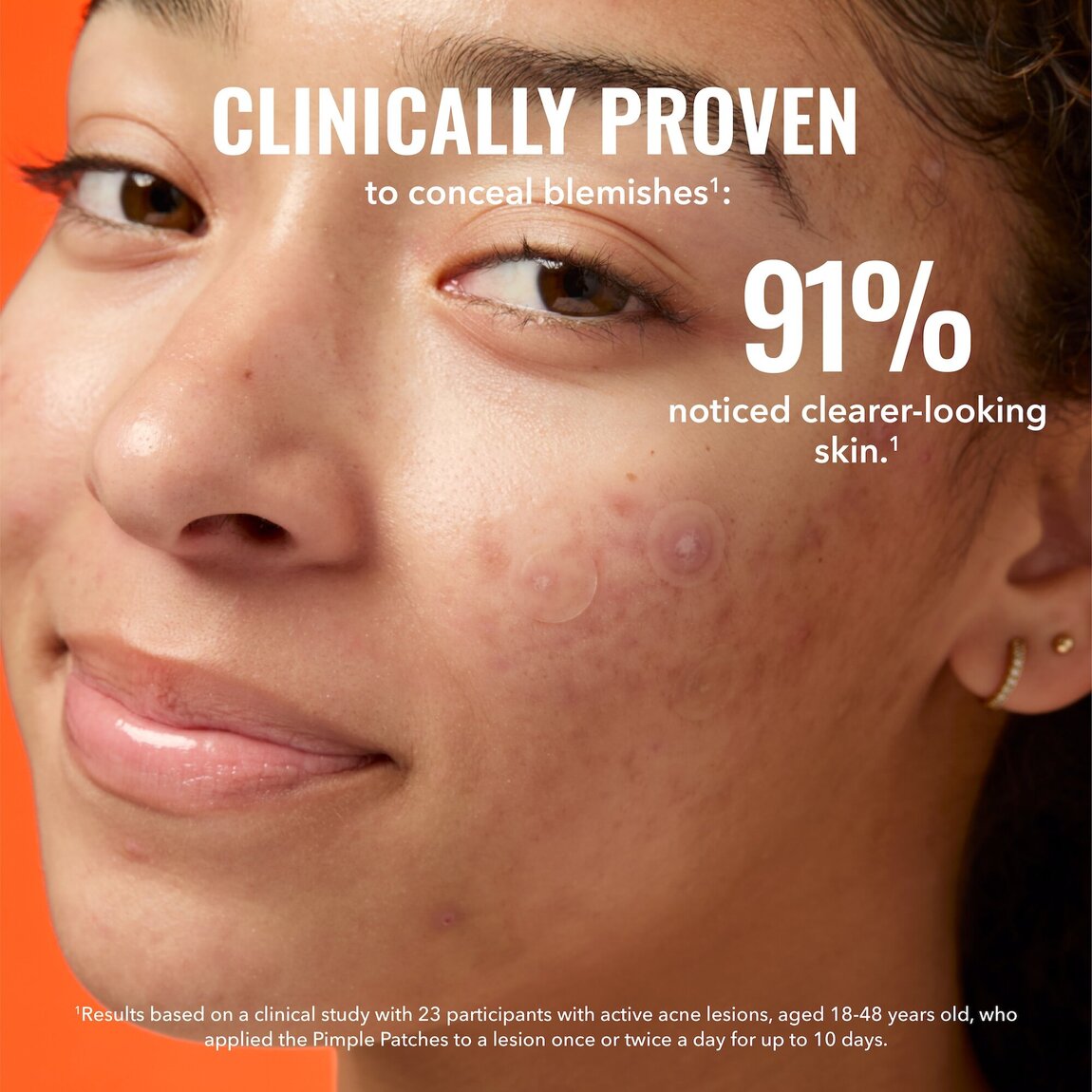 pimple-patches-f5 zb_p.jpg