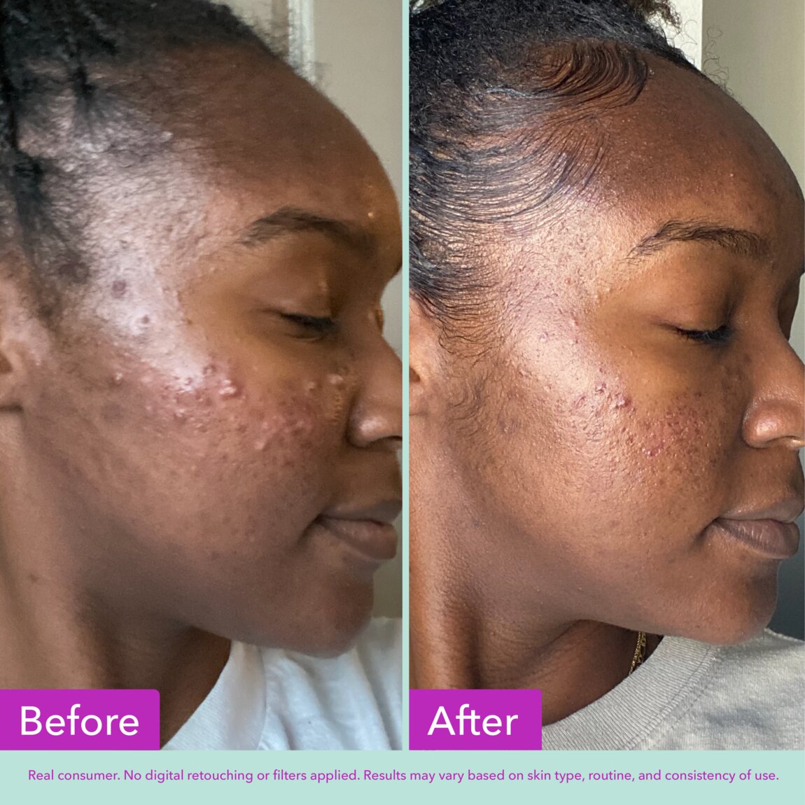 acne-foaming-cleanser-h0 zb_p.jpg